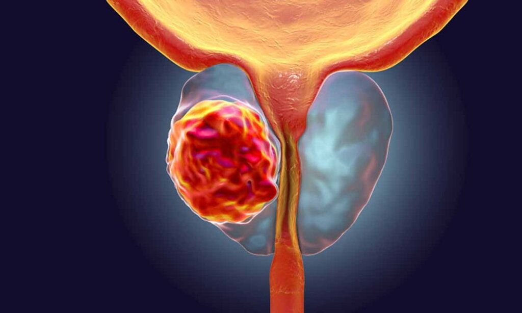 APDPróstata quer que homens mostrem “cartão vermelho ao cancro da próstata”