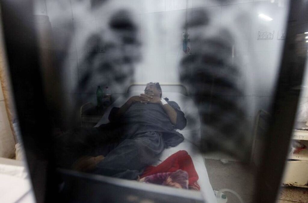 Relatório indica que risco de tuberculose é quatro vezes superior entre imigrantes