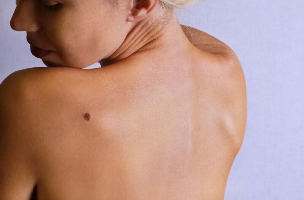 Estudo aponta que um em cada cinco melanomas ficaram por diagnosticar no ano passado