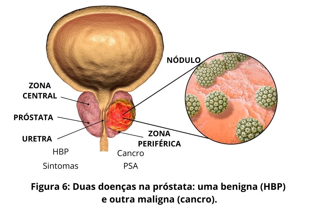 Próstata: Hiperplasia Benigna da Próstata vs Cancro