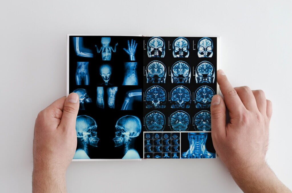 Estudo realizado por Coimbra permite avanço no diagnóstico da esclerose múltipla