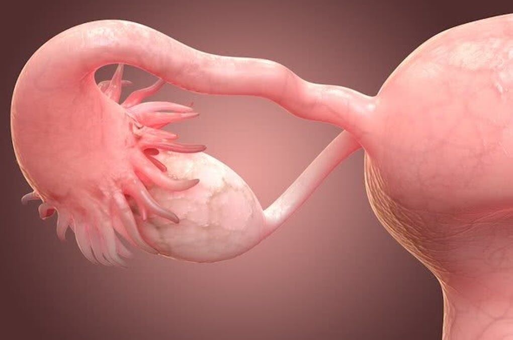 Sociedade alerta que oito em cada 10 casos do cancro do ovário são detetados em fase avançada