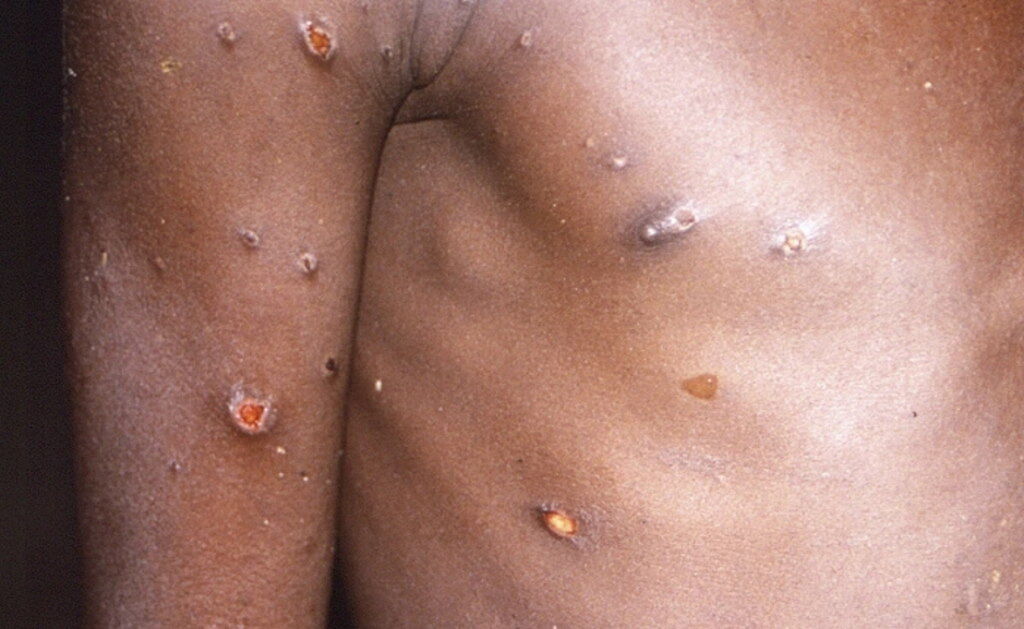 Brasil regista primeiro caso de Monkeypox