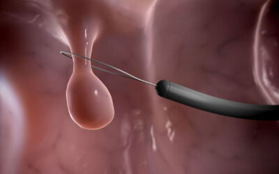 SPG reforça “urgência” para a prevenção do cancro do intestino