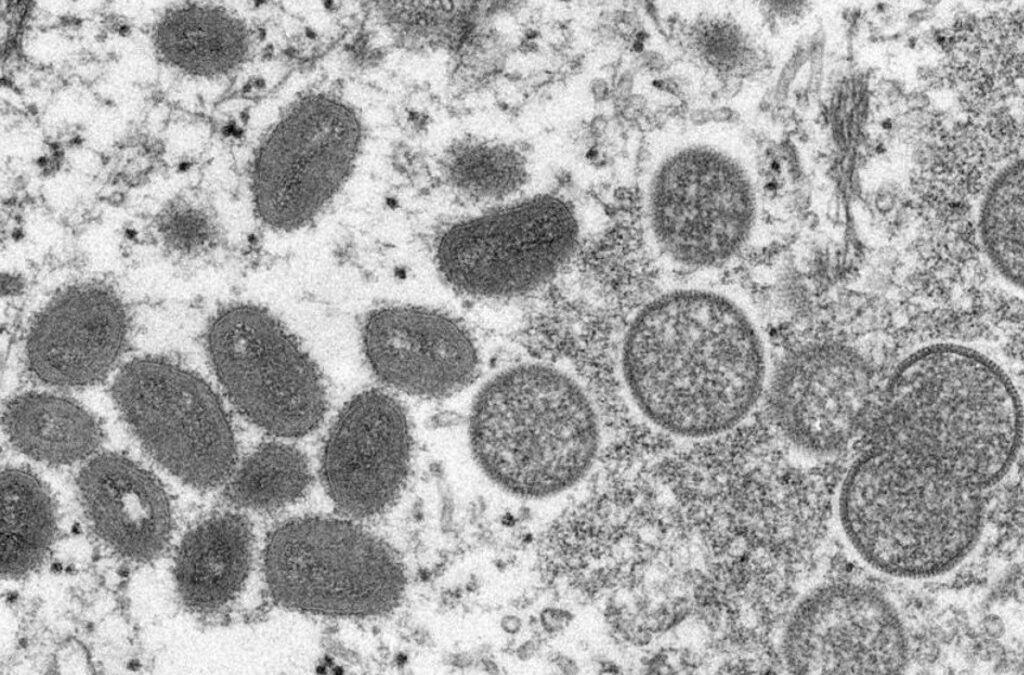 Portugal atingiu os 100 casos confirmados de infeção por vírus Monkeypox