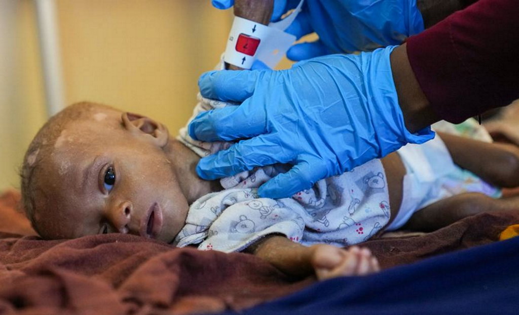 Cerca de 200 crianças morreram na Somália desde janeiro por desnutrição