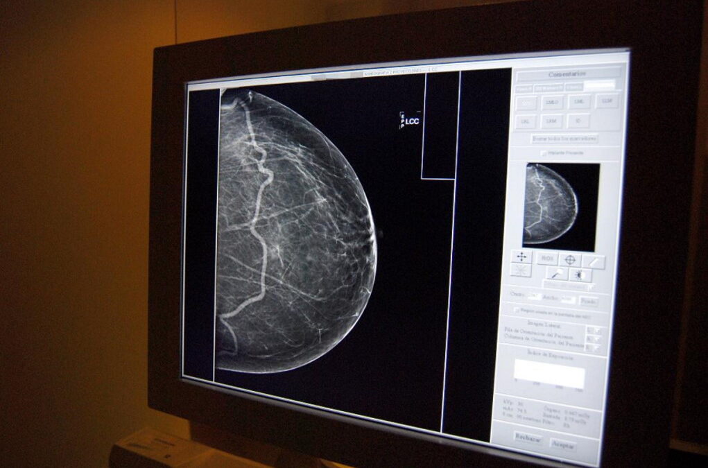 LPCC diz que afluência ao rastreio do cancro da mama está aquém do esperado na região Sul