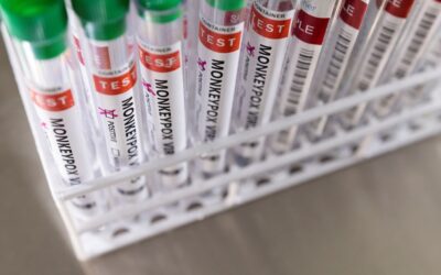 Complicações detetadas em 40% dos pacientes com Monkeypox