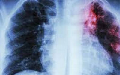 Campanha nacional alerta para importância do diagnóstico precoce da fibrose pulmonar