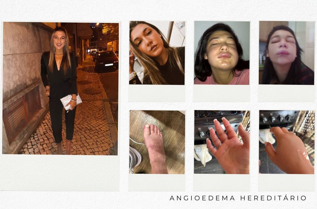 Inês Rodrigues: “Os doentes com AEH acabam por não ser pessoas ‘normais'”
