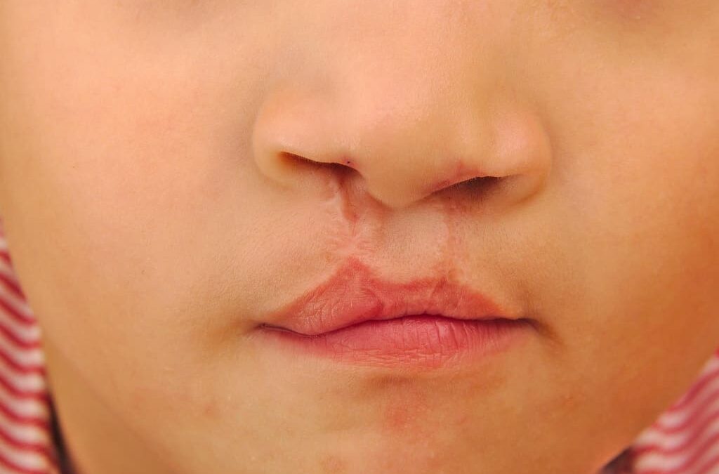 Identificado gene responsável por defeitos faciais graves de síndrome de Goldenhar