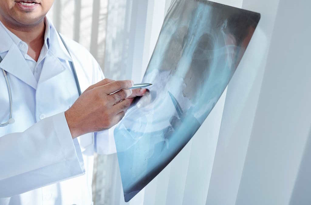 Diagnóstico precoce e rastreio são fundamentais para combater o cancro do pulmão