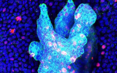Investigadores Desvendam Mecanismos do Cancro da Pele Mais Comum