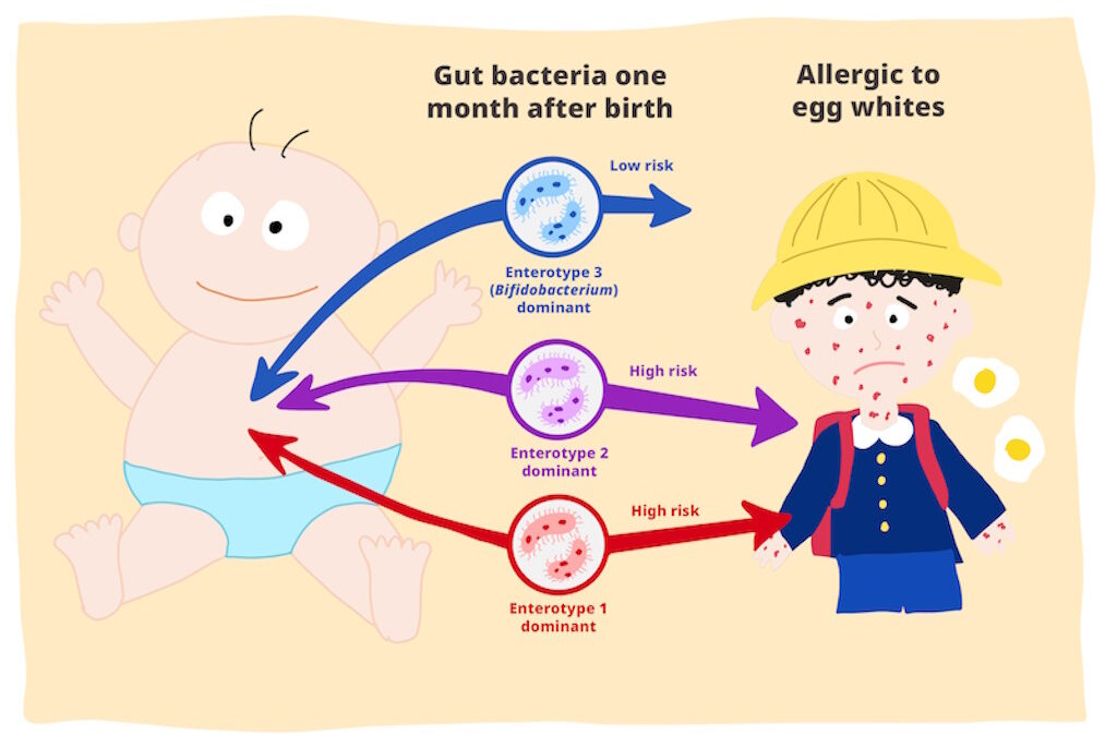 Bifidobacterium: aliado contra alergias alimentares em bebés