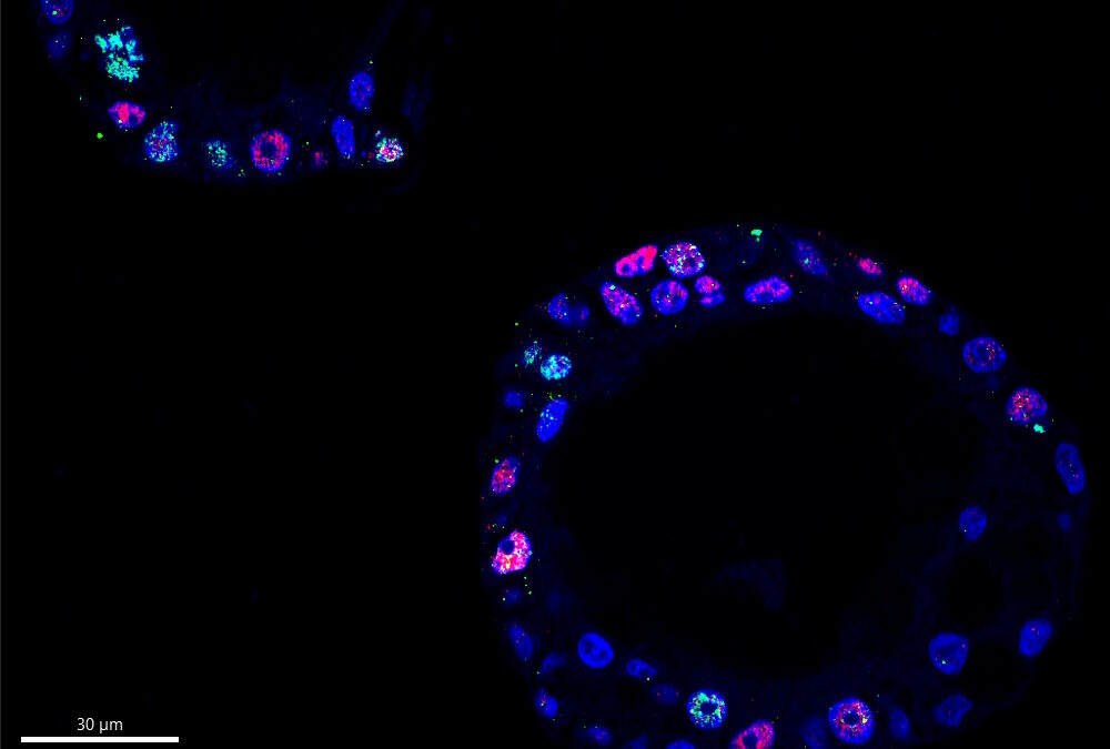 Investigadores descobrem como círculos de ADN tornam cancro do pâncreas agressivo