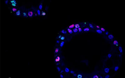 Investigadores descobrem como círculos de ADN tornam cancro do pâncreas agressivo