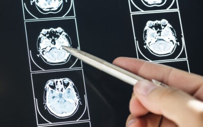 Algarve distinguido pela sua capacidade em detetar e tratar casos de AVC