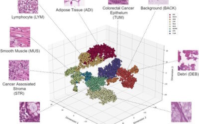 IA Revoluciona Análise de Cancro Colorretal