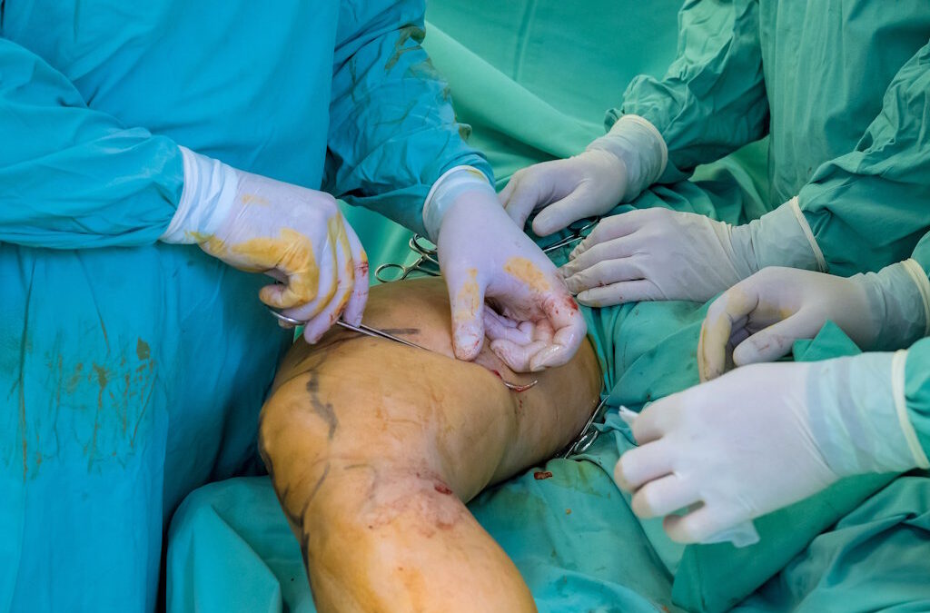 Quénia faz primeira cirurgia mundial de restauro de sensibilidade a pacientes amputados