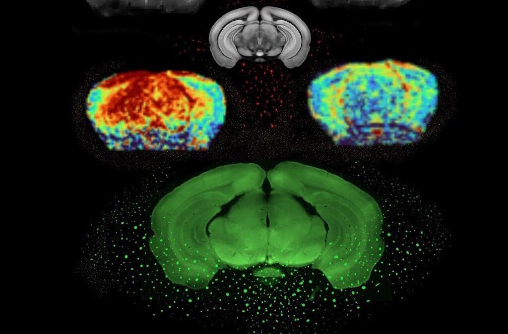 Novo avanço permite detetar Parkinson anos antes dos sintomas