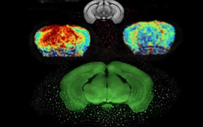 Novo avanço permite detetar Parkinson anos antes dos sintomas
