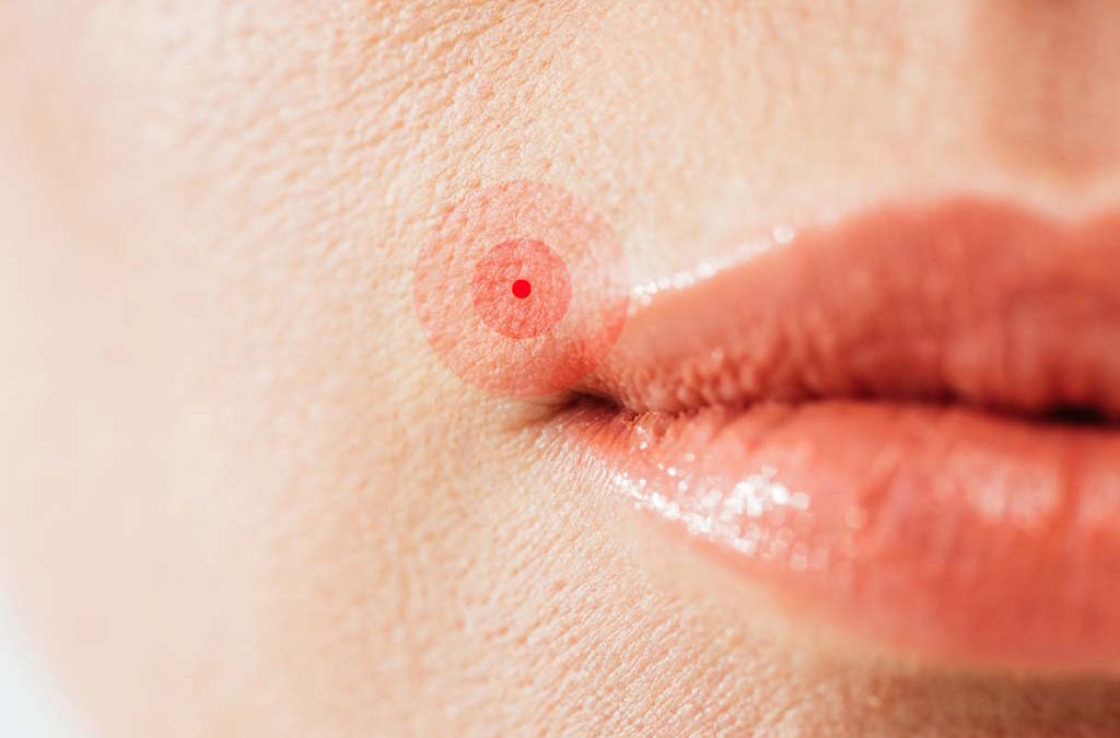 Investigação mostra como o herpes labial engana o genoma humano para se multiplicar