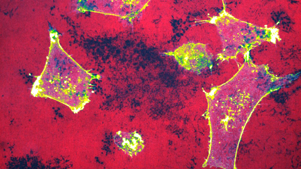 Nova ferramenta de visualização revela como travar a disseminação do cancro da mama